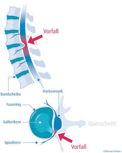 Schema Bandscheibenvorfall