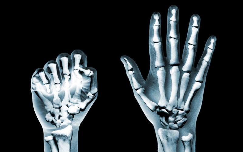 Täglich Rheumabeschwerden in den Fingergelenken